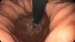 Скользящая аксиальная грыжа большого размера, недостаточность кардиального жома.